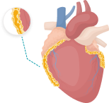 Illustration of pericardial mesothelioma cancer