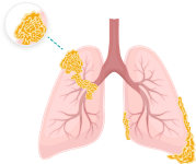 Illustration of pleural mesothelioma cancer in the lining of a patient's right lung