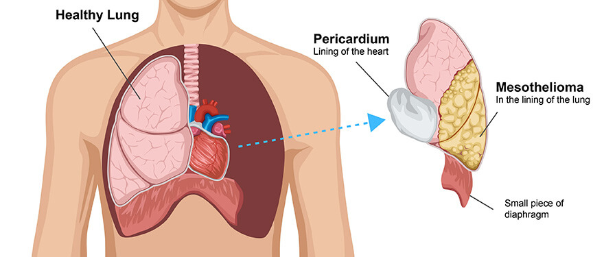 Illustration of an xtrapleural pneumonectomy with the patient's left lung removed along with the pericardium and a small piece of the diaphragm