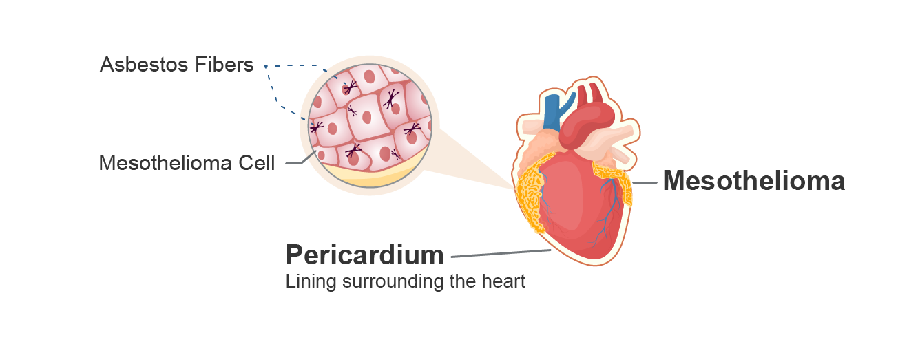 An illustration shows how pericardial mesothelioma forms on the protective sac-like lining of the heart known as the pericardium