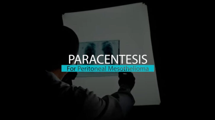 Paracentesis for Peritoneal Mesothelioma | Mesothelioma Hope Video Thumbnail