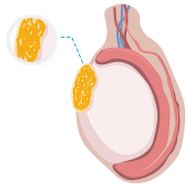 Illustration of testicular mesothelioma cancer